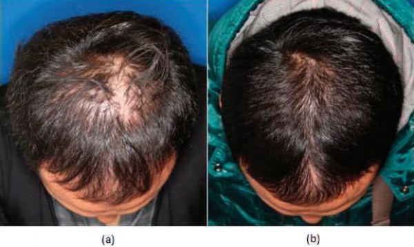 Regenerating Your Own Hair With Stem Cells - Regenerative Medicine Now