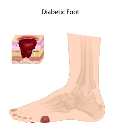 New Research into Diabetic Foot Ulcers and Stem Cell Treatment ...